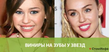 Виниры на зубы у звезд